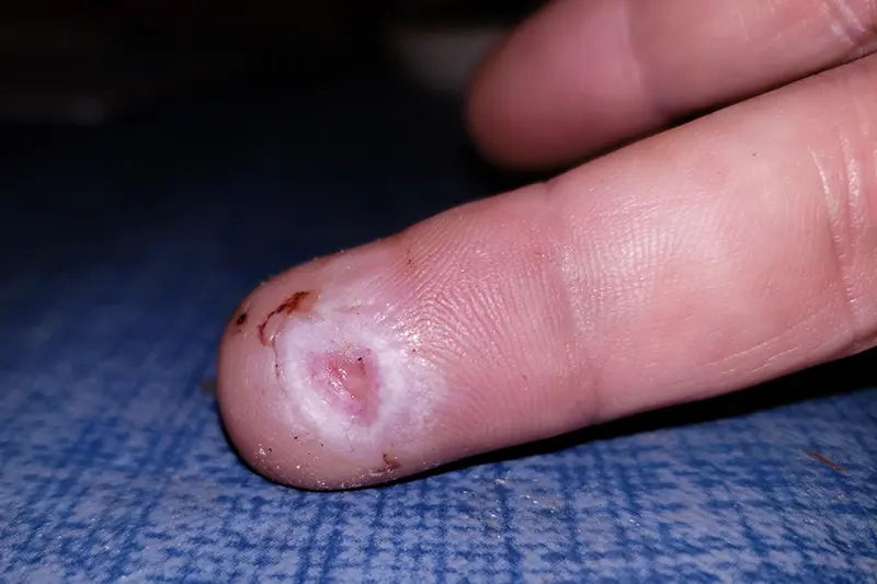 My finger after crushing it