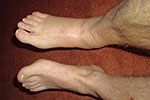 The swelling of my right foot