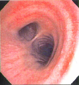 lung endoscopy