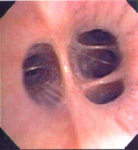 lung endoscopy