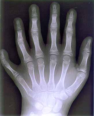 X-Ray of six fingered hand