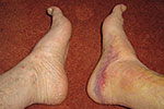 The bruising on my right foot