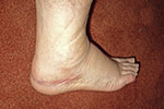 The swelling and bruising of my right foot