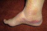 The swelling and bruising of my right foot