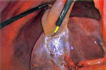 Cutting the gall bladder away from the liver