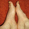 See the swelling of my left foot?