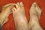 My feet showing the swelling of my left foot and the blister on the middle toe
