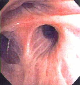 lung endoscopy