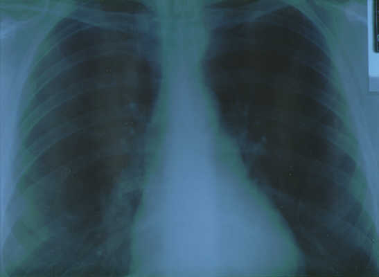 Lung x-ray from July 2001 
